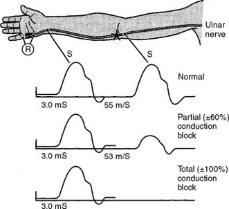 Nerve conduction study